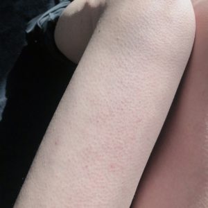 【メンズ脱毛】RBLで脱毛5回目で2週間放置してみた【効果検証】