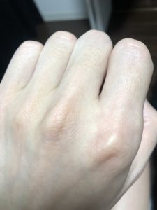 【脱毛10回通った僕が答える】気になるメンズ脱毛の痛みは？料金など含め解説！【SHR脱毛】