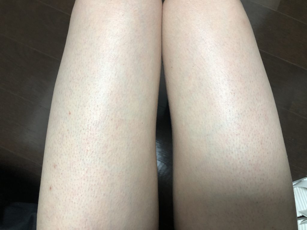 【RBL】ローランドの脱毛サロンで全身脱毛12回目を1カ月放置してみた【気になる効果】