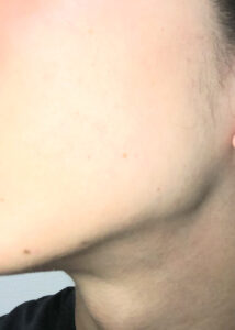 結局のところ肌質改善はストレスを溜めないことだと思った話