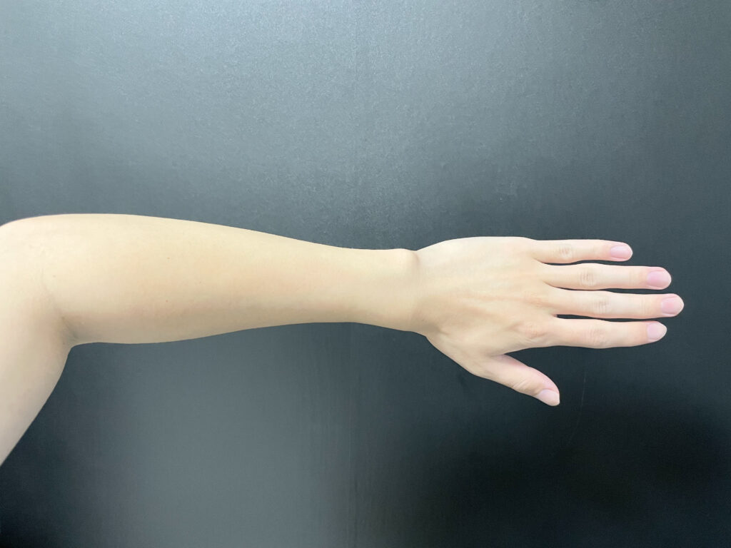 【20回目】RBL脱毛を20回通った僕が答える驚きの効果とは？