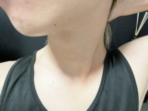 【脱毛23回目を1カ月放置】上半身から毛が全く生えてこない件について