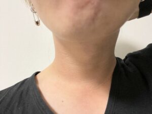 【卒業】ローランドの脱毛サロンを24回通ってついに満足いく結果に