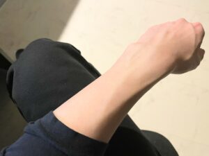 【ぶっちゃけレビュー】医療脱毛を終えて1カ月経過した結果どんな感じ？写真付きで解説