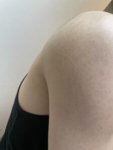 【脱毛34回目記録】医療脱毛が終わったあとと前後の比較