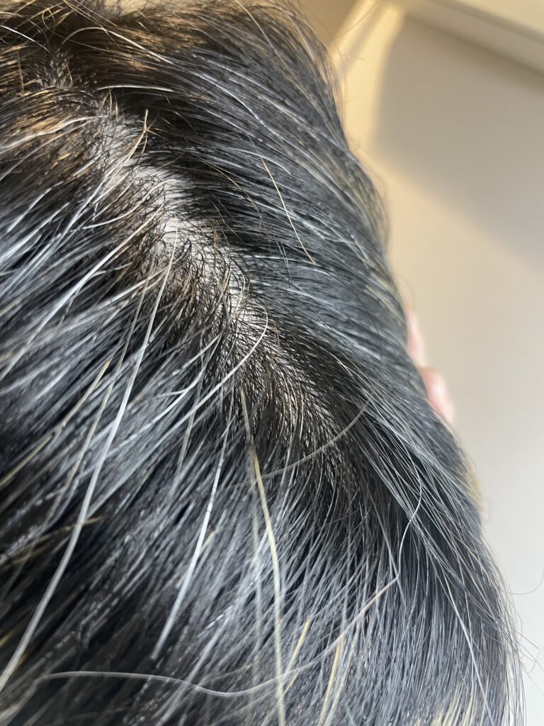【検証】レプロナイザー107Dは白髪に効果ある？2カ月使ってみた結果【結論：効果なし】